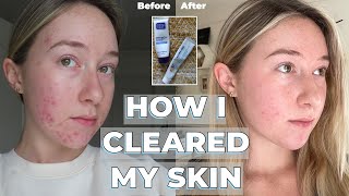 Adapalene Gel amp Benzoyl Peroxide transformation  skincare routine  HOW I CLEARED MY SKIN [upl. by Aja]