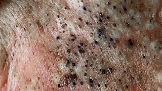 Shockingly large blackheads removal [upl. by Butte]