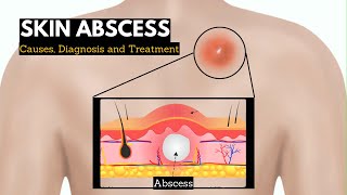 Skin Abscess Causes Signs and Symptoms Diagnosis and Treatment [upl. by Dunaville]