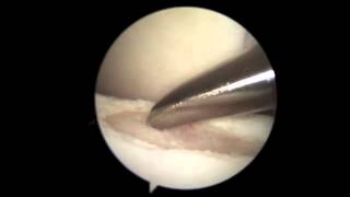 AllInside ACL Reconstruction with Arthrex® GraftLink® [upl. by Enneles]