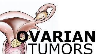 Ovarian Pathology amp Tumors [upl. by Loats]