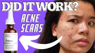 1 MONTH OF RETINOL 1 IN SQUALENE ON ACNE SCARS REVIEW ampRESULTS THE ORDINARY RETINOL FOR ACNE SKIN [upl. by Esiuolyram130]