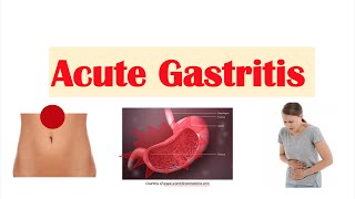 Acute Gastritis Stomach Inflammation  Causes Signs amp Symptoms Diagnosis Treatment [upl. by Palermo166]