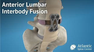 Anterior Lumbar Interbody Fusion ALIF [upl. by Olodort702]