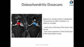 Arthroscopic Knee Surgery Meniscus Tear [upl. by Kyte]