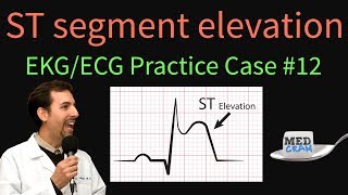 ST Elevation  EKG  ECG Interpretation Case 12 STEMI MI ACS [upl. by Nnylrac866]