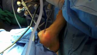 Ankle Arthroscopy [upl. by Vaasta54]