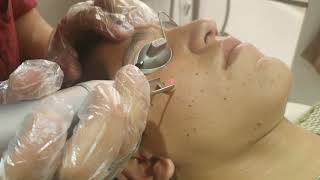 Freckles treatment with laser by Dr Syed Bilal Shams dermatologist and Cosmetologist [upl. by Darya]