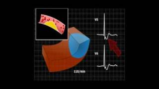 EKG  migotanie przedsionków [upl. by Whetstone]