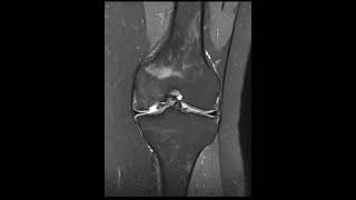 Osteochondritis dissecans [upl. by Bari340]