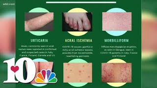 Doctor Skin rash could be a symptom as possible COVID19 symptom [upl. by Harty]