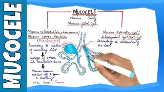 Mucocele  Types Clinical Features Histopathalogic features amp Treatment [upl. by Sharma]