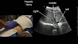 Triphasic CT of HCC شرح [upl. by Breen]