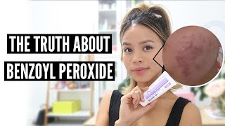 Clear Acne With Benzoyl Peroxide Pros and Cons [upl. by Leiad]