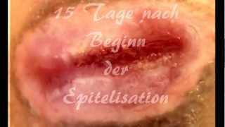 Wundheilung mit VAC Therapiesystem der Firma KCIwmv [upl. by Crystie]