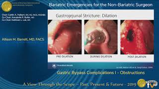 Gastric Bypass Complications I  Obstructions [upl. by Yerfoeg289]