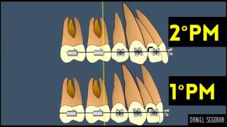 Extracción de segundos premolares en ortodoncia [upl. by Norved581]