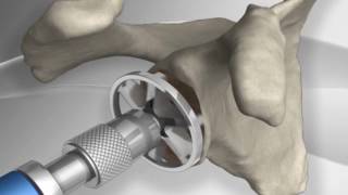 The CORRECT Way to Use a CANE After Knee Replacement Surgery [upl. by Dewitt]