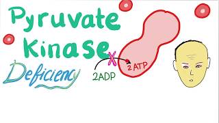 Pyruvate Kinase Deficiency  Hemolytic Anemia [upl. by Nira]