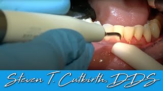 Scaling amp Root Planing  Dental Minute with Steven T Cutbirth DDS [upl. by Fronia728]