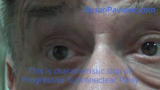 Progressive Supranuclear Palsy [upl. by Aitan734]