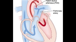 Patent Ductus Arteriosus [upl. by Ailisab260]