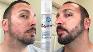 How to grow a REAL Beard  Minoxidil 4 Month Beard Journey [upl. by Janka]