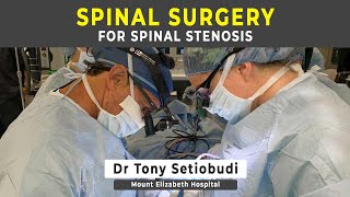 SURGERY FOR SPINAL STENOSIS [upl. by Carmelina]