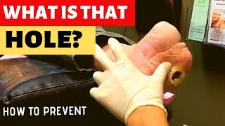 HOW WE TREAT DIABETIC WOUNDS [upl. by Rubbico]