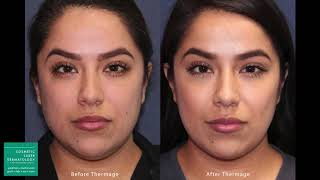 Thermage Skin Tightening Treatment by Leysin Fletcher PAC  Cosmetic Laser Dermatology San Diego [upl. by Wells]