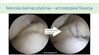 Menisko šaknies plyšimai [upl. by Loriner]