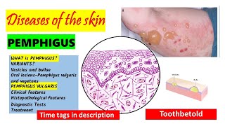 Pemphigus Vulgaris  HISTOPATHOLOGY  Immunofluorescence  Treatment  PART 22 [upl. by Antonie]