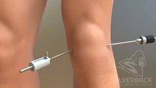 Knee Surgery Recovery Essentials  TTO MPFL OCA amp Lateral Lengthening [upl. by Issor]