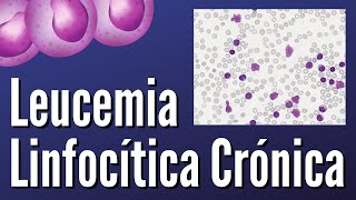 Leucemia Linfocítica Crónica [upl. by Evvy]