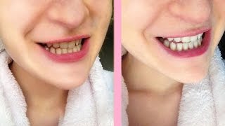 Crest white strips honest review [upl. by Malti]