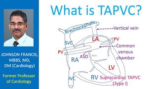 What is TAPVC Cardiology Basics [upl. by Oscar286]