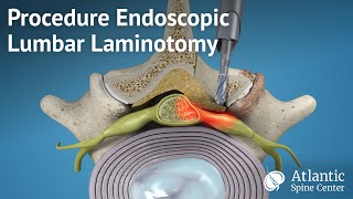 Procedure Endoscopic Lumbar Laminotomy [upl. by Einavoj]