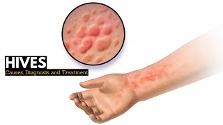 HIVES Causes Signs and Symptoms Diagnosis and Treatment [upl. by Lletnuahs]