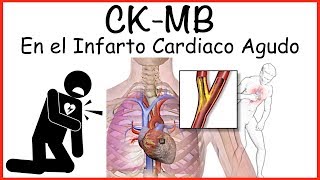 CK MB Uso en Infarto Cardiaco [upl. by Llenehs]