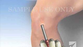 Knee Arthroscopy [upl. by Traver]