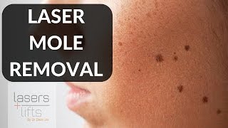 LASER MOLE REMOVAL [upl. by Ocer]