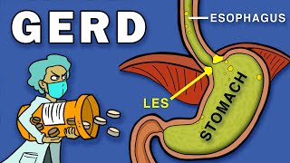 Gastroesophageal Reflux Disease GERD [upl. by Pollitt260]