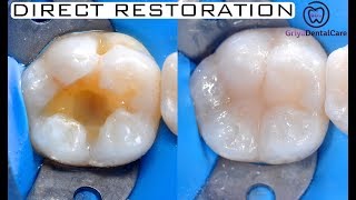 Replacing Amalgam  Direct Restoration Class I Composite [upl. by Andromeda]