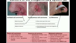 Anatomy  The Three Types of Skin Cancers [upl. by Mona]