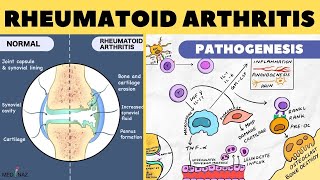 Rheumatoid Arthritis Pathophysiology  Rheumatoid Arthritis Pathogenesis  Arthritis pathophysiology [upl. by Henson]