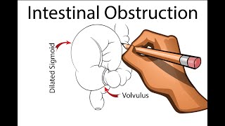 Intestinal Obstruction  Part 1 [upl. by Anelram]