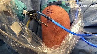 Do I Need A Knee Scope Knee Arthroscopy [upl. by Jocelyn]