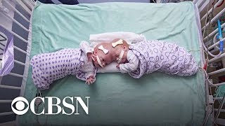 How doctors separated twin girls conjoined at the brain [upl. by Nodnarbal]