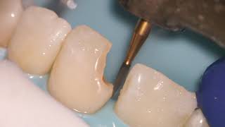 Teeth Bonding  Front tooth filling EXPLAINED [upl. by Boser]