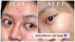 Rekomendasi Skincare utk Jerawat kombinasi berminyak [upl. by Schober]